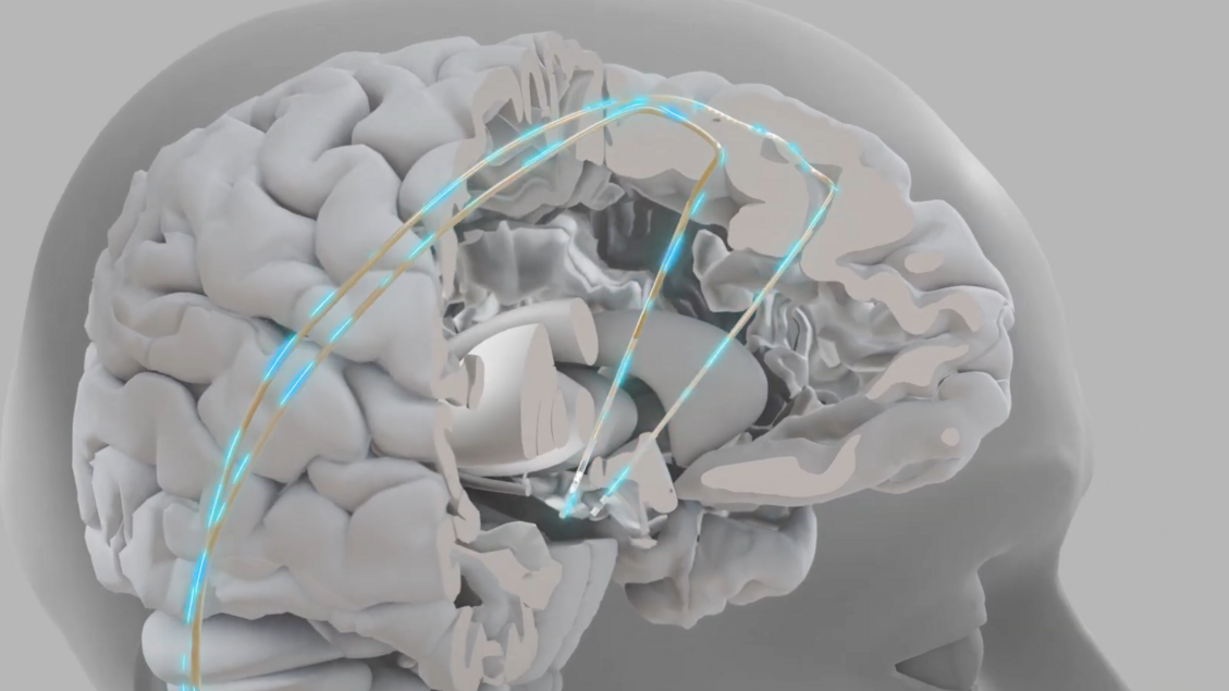 Chip impiantabili più vicini, aiutano a parlare e a camminare VIDEO - Frontiere - Ansa.it